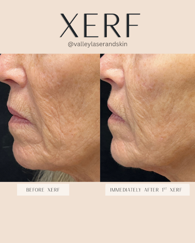Xerf Before & After