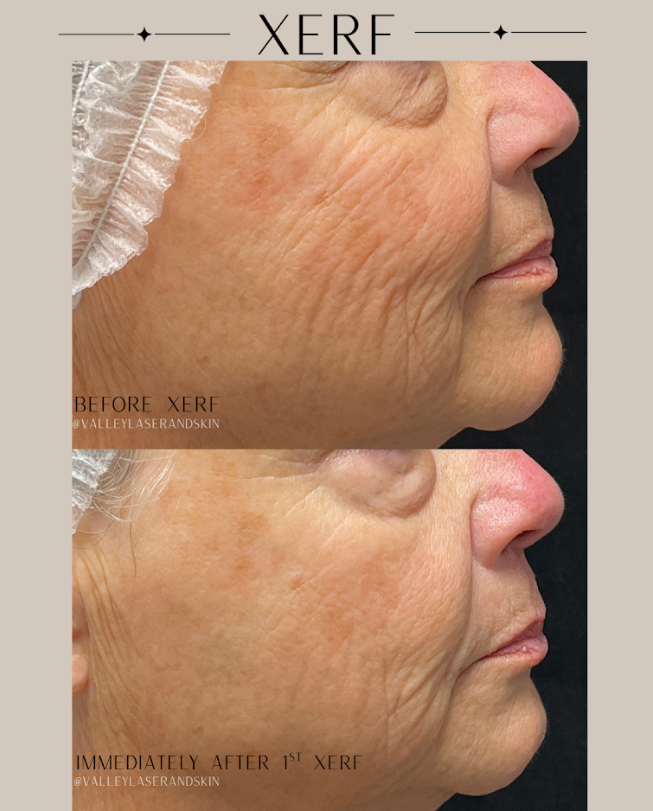 Xerf Before & After